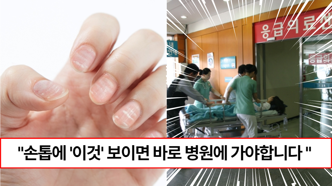 “손톱에 이런 줄 보이면 병원가세요” 손톱 모양만으로 7가지 질병알 수 있는 방법