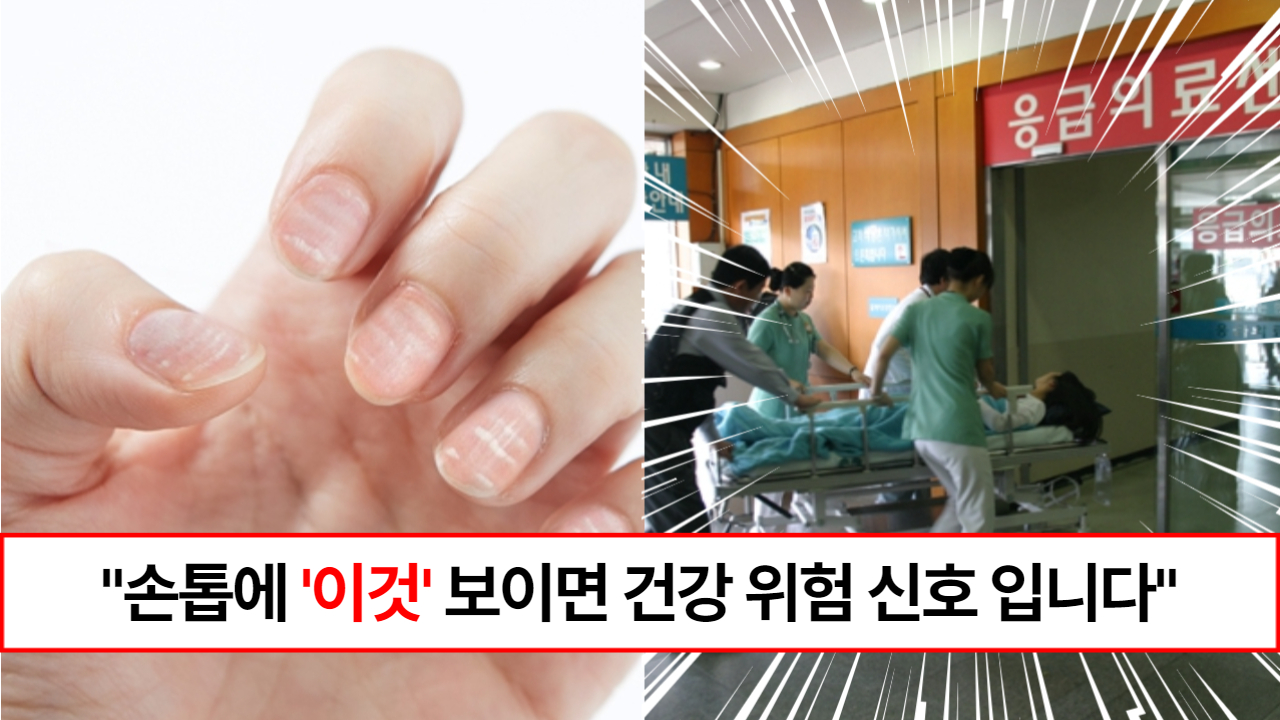 “손톱에 이런 줄 보이면 병원가세요” 손톱에 나타나는 건강 위험 신호 7가지